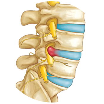 Slipped Disc