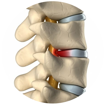 Spinal Cord Injur