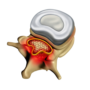 Spinal Stenosis